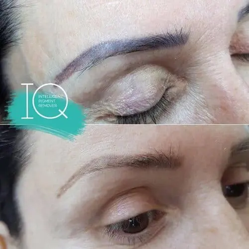 IQ Remover vorher nachher Augenbrauen 1 Vorher-nachher: dunkel verfärbtes Augenbrauen-Permanent-Make-up vor und nach der Entfernung mit IQ Remover