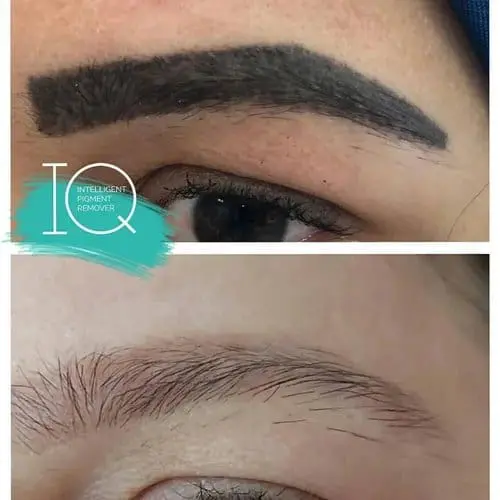 IQ Remover vorher nachher Augenbrauen 2 Vorher-nachher: kräftig schwarzes Augenbrauen-Permanent-Make-up vor und nach der Entfernung mit IQ Remover