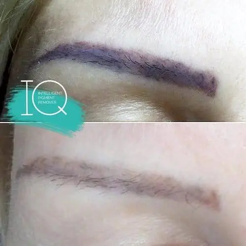 IQ Remover vorher nachher Augenbrauen 3 Vorher-nachher: violett verblasstes Augenbrauen-Permanent-Make-up vor und nach der Entfernung mit IQ Remover