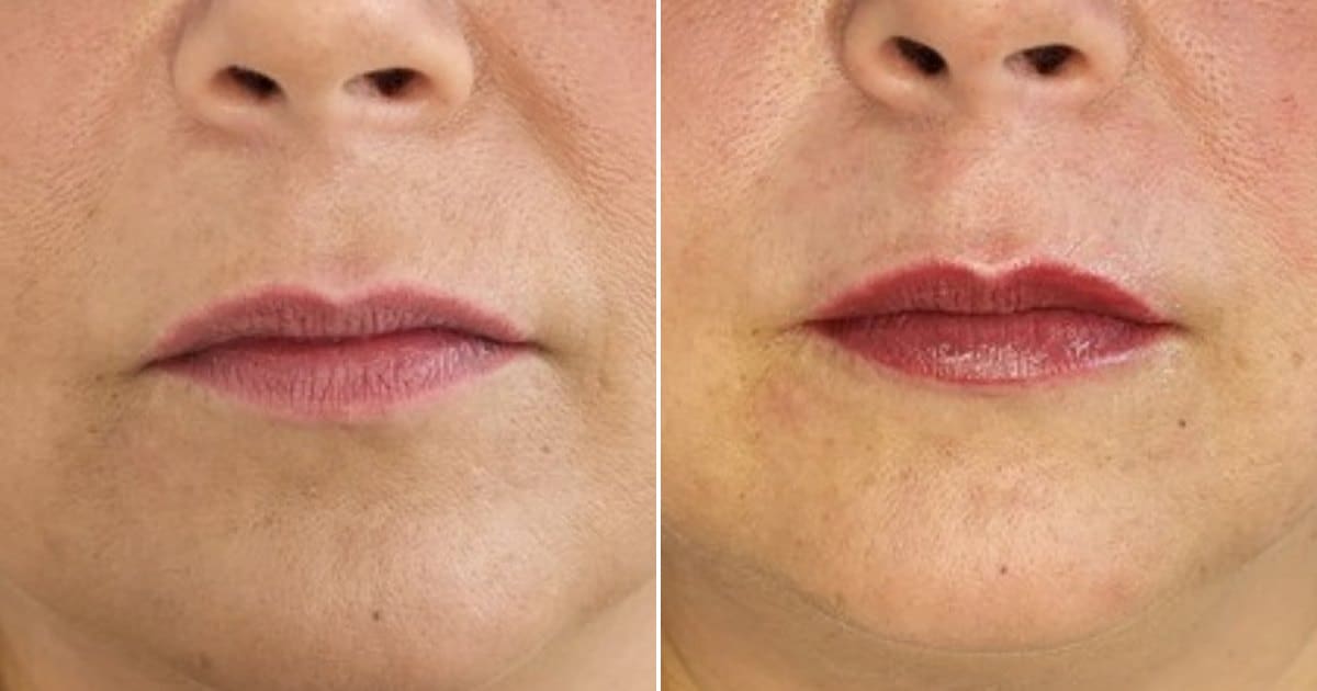 Permanent Make-up Lippen vorher und nachher, Lippenkontur und Farbe